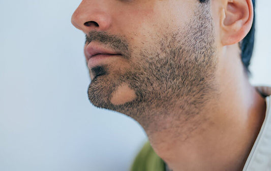 Beard Care Mistakes